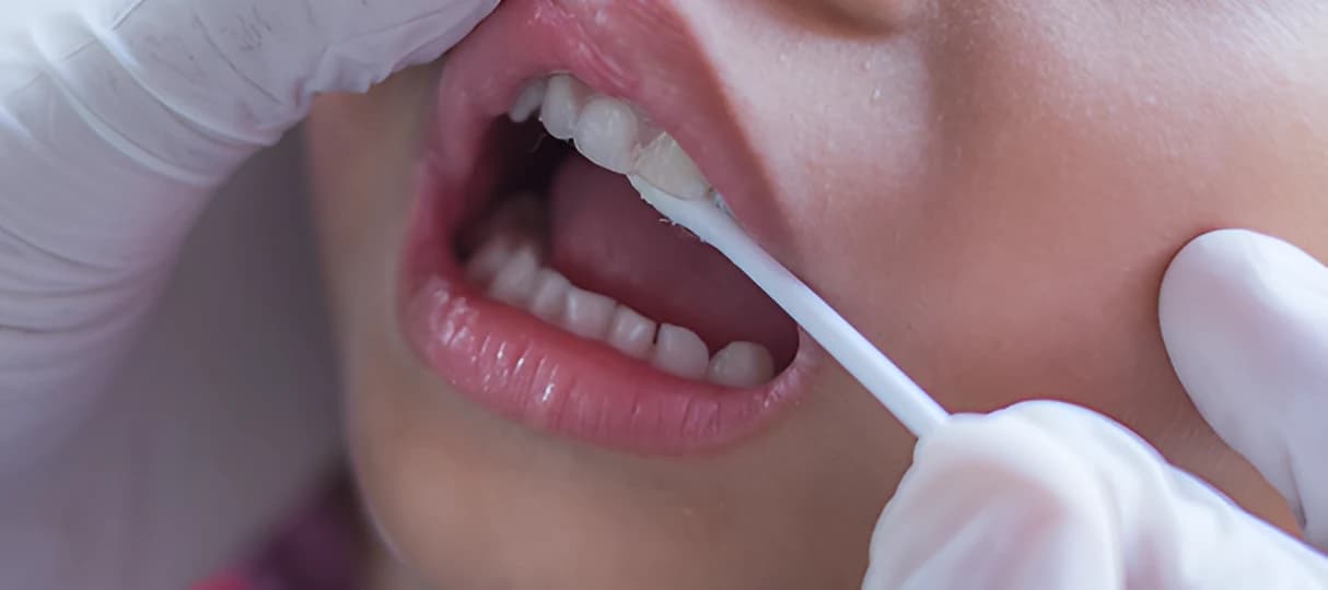 Fluoride treatment for kids in Ajmer by Dr. Nikita Sharma